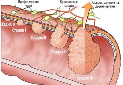 Стадии рака толстой кишки